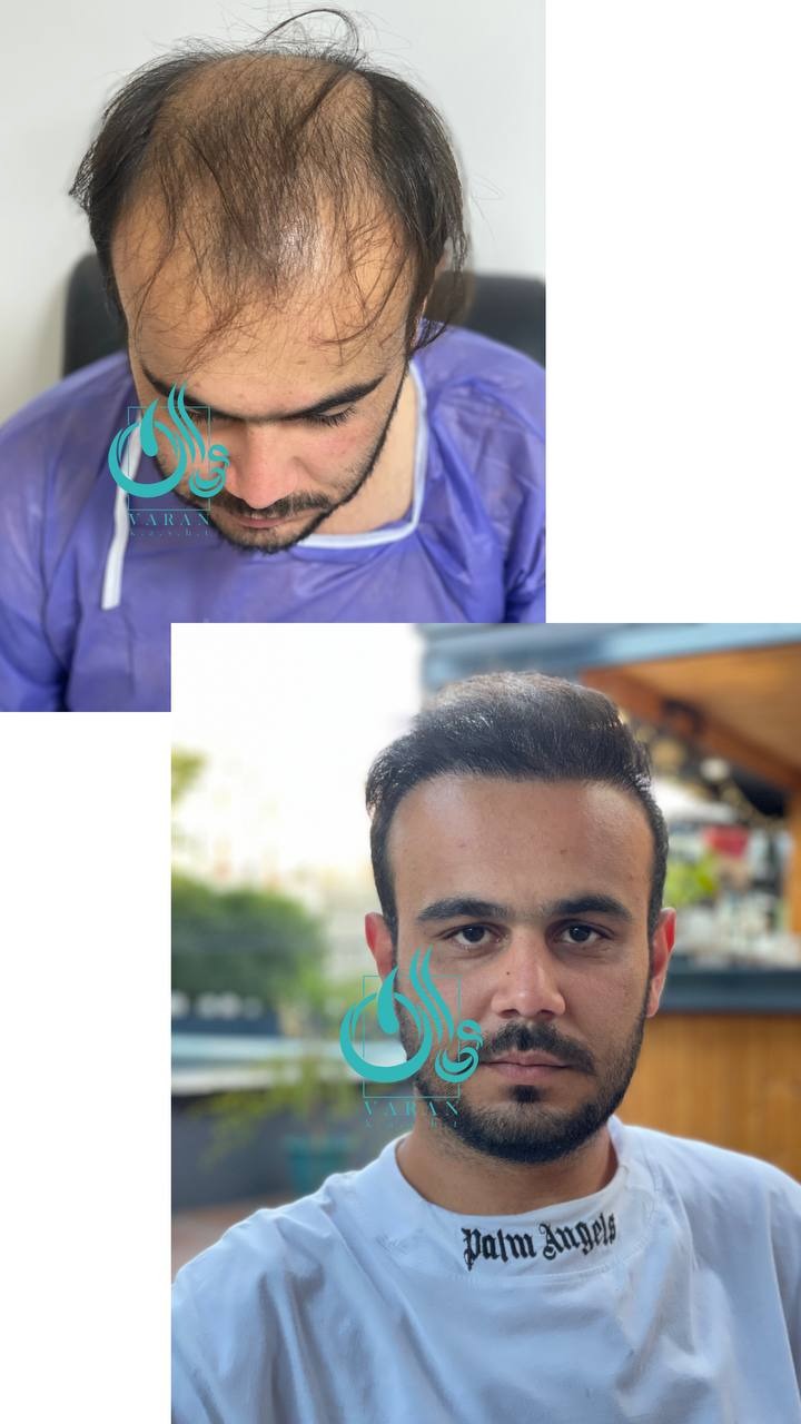 کلینیک کاشت مو و ابرو واران