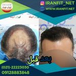 کاشت مو ایران فیت