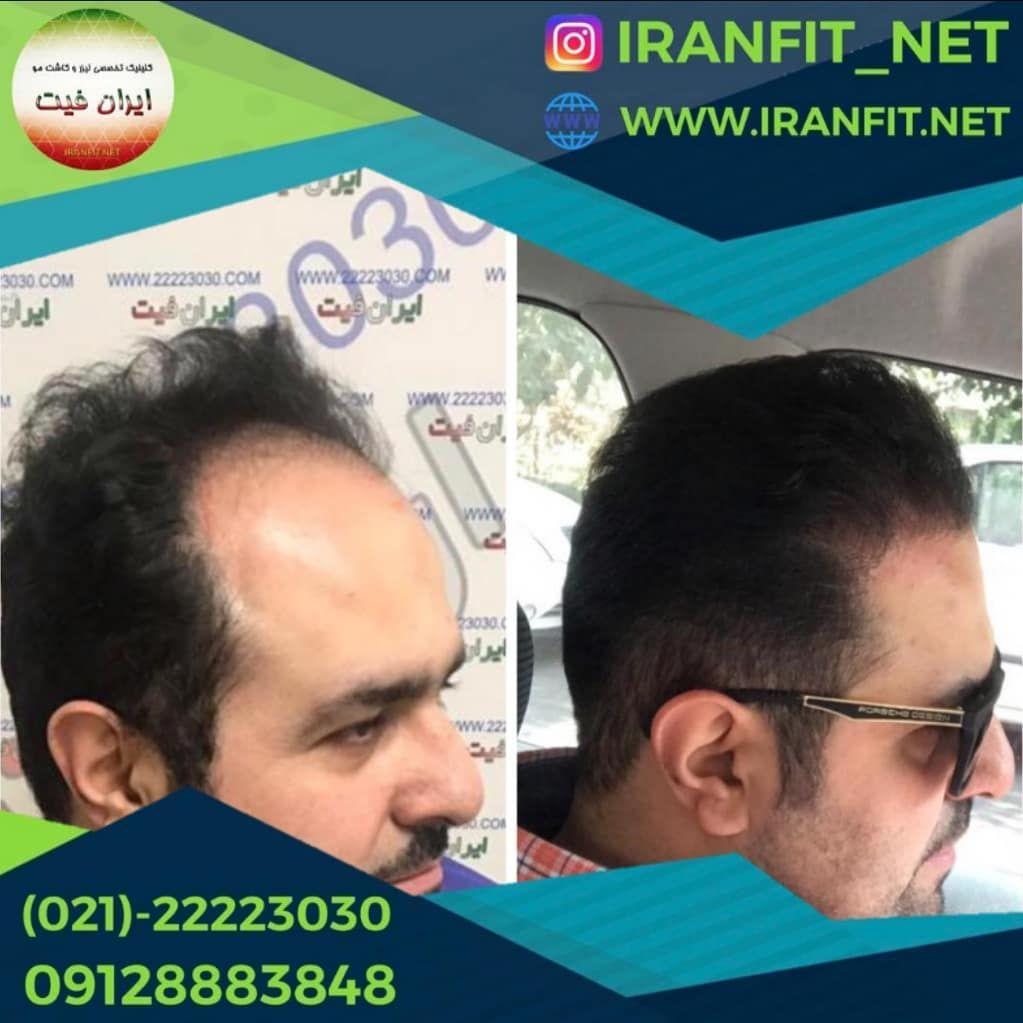 تصویر محیط کاشت مو ایران فیت