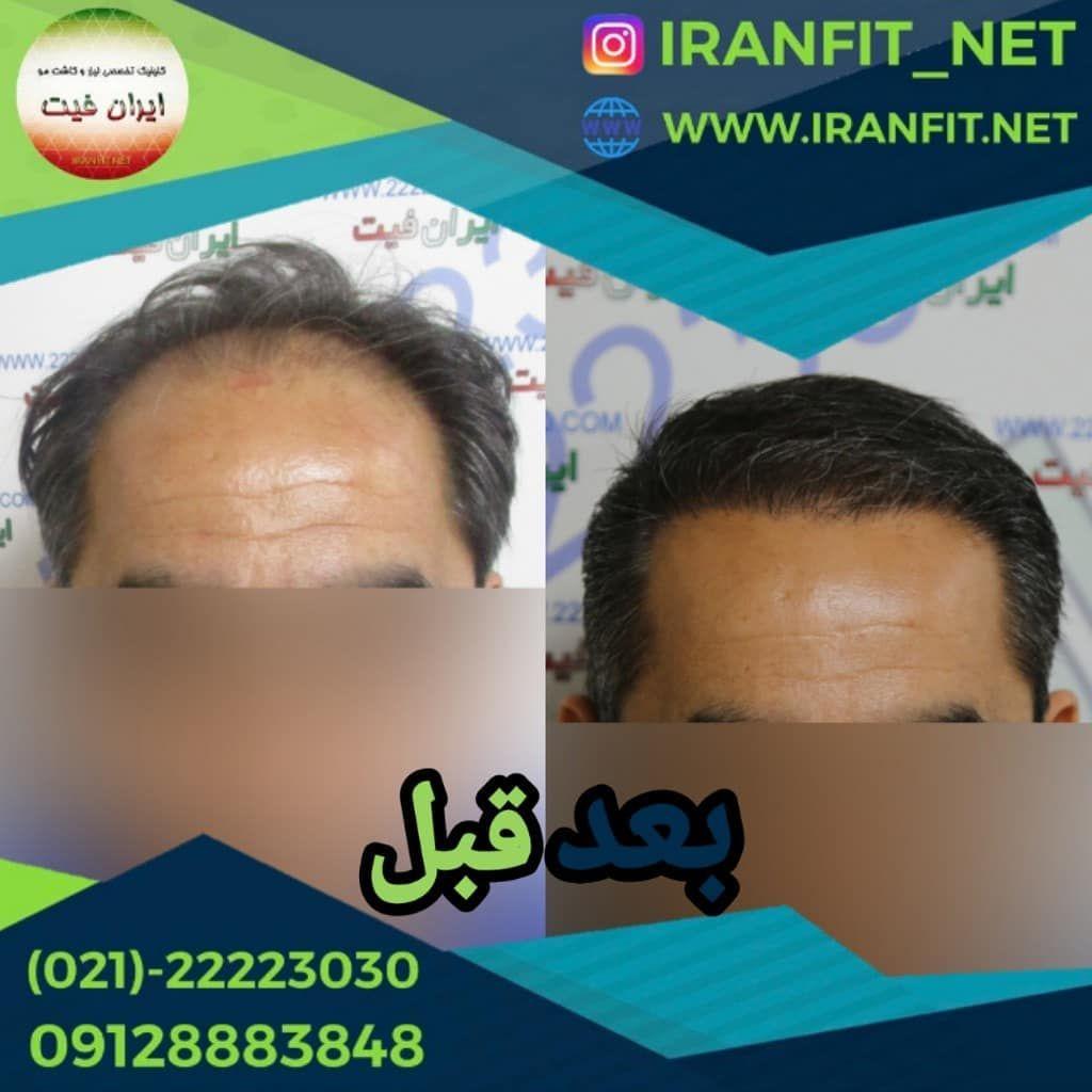 تصویر محیط کاشت مو ایران فیت