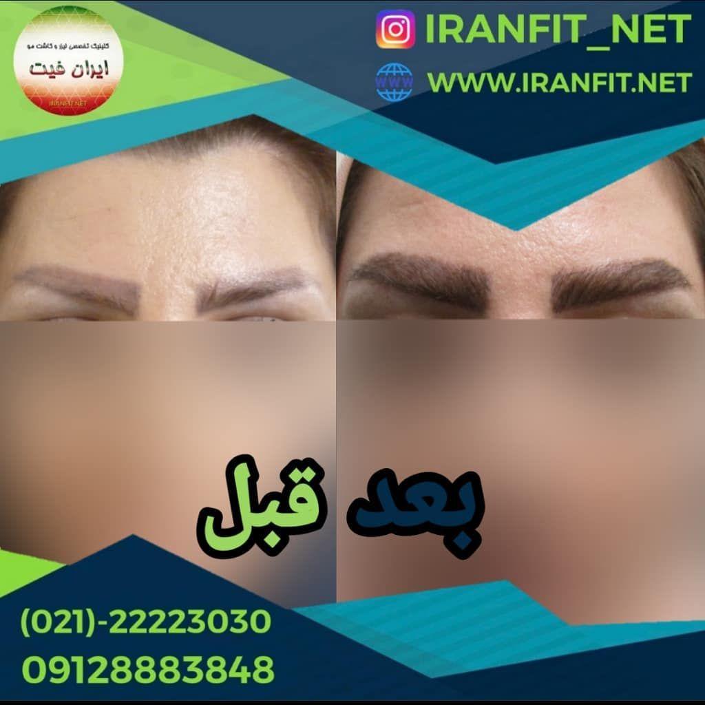 تصویر محیط کاشت مو ایران فیت