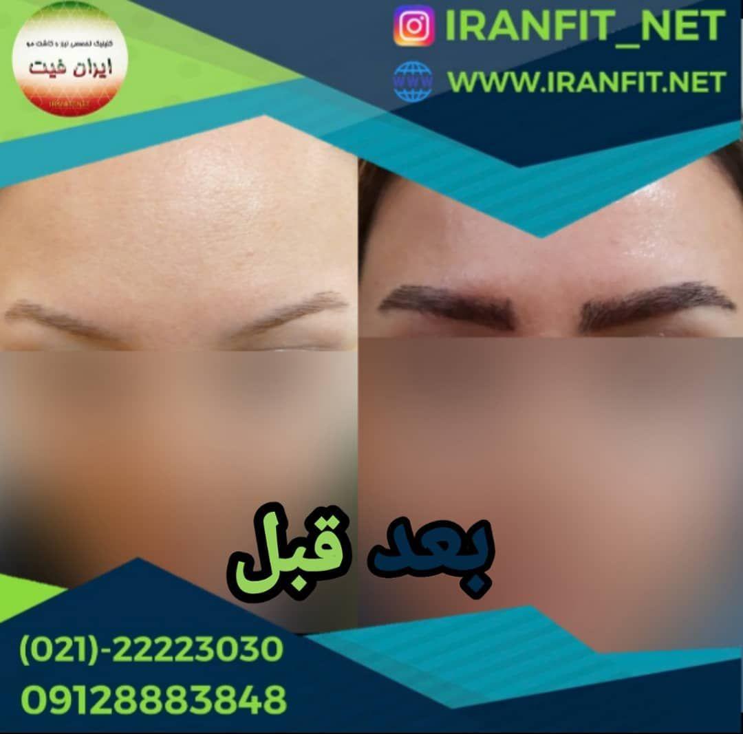 تصویر محیط کاشت مو ایران فیت